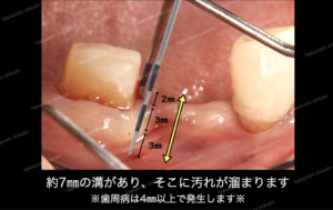 歯周病　歯周外科治療について　歯周ポケットを測定します。4㎜以上で歯周病が発生しますが、これは7㎜あると判断し、重度歯周炎とわかります。